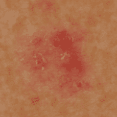 basal-cell