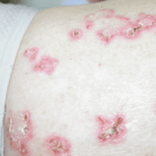 eczema