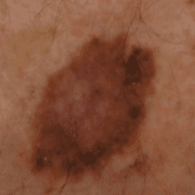 melanoma