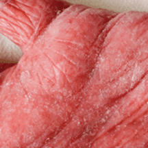 psoriasis