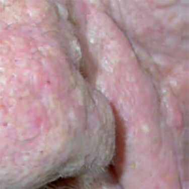 rosacea