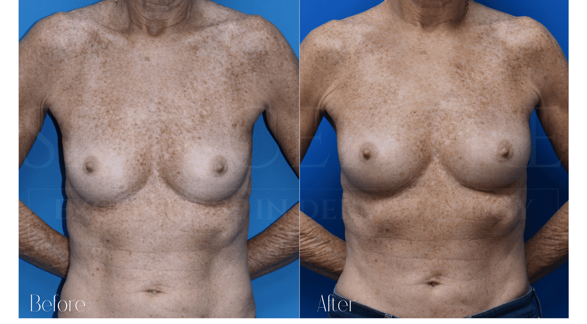 Natural Breast Enlargement - Skin Centre